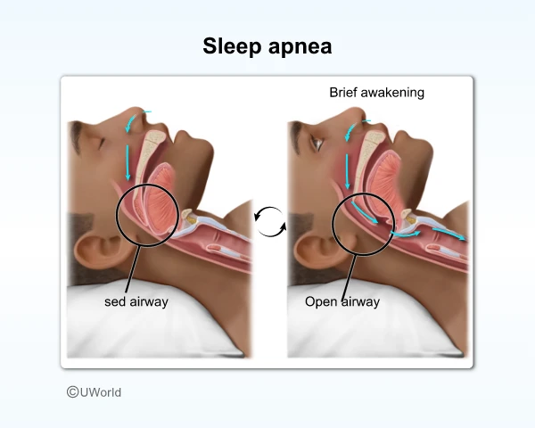 Image showing what causes sleep apnea.